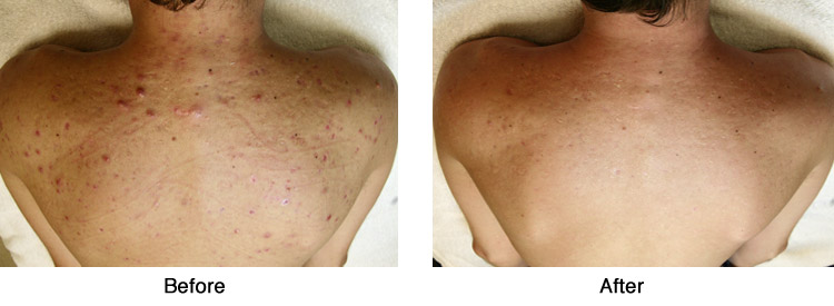 Before and after rosacea laser treatments, back acne ...