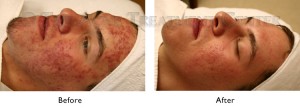 Acne Pictures, Acne Photos | Pictures of Acne, Photos of Acne | Before and After Hyperpigmentation, Inflamed Acne