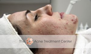 Combination Acne Treatment Photo