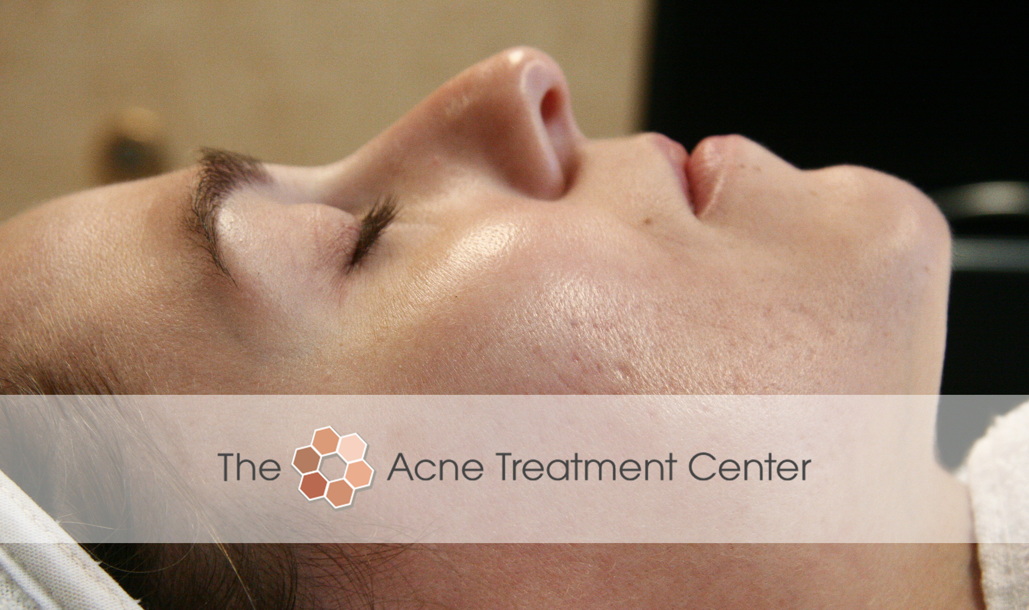 Combination Acne Treatment Photo | Acne Treatment Center | Portland OR