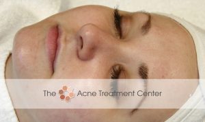 Combination Acne Treatment Photo