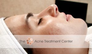 Inflamed Acne Treatment Photo