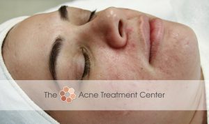 Inflamed Acne Treatment Photo