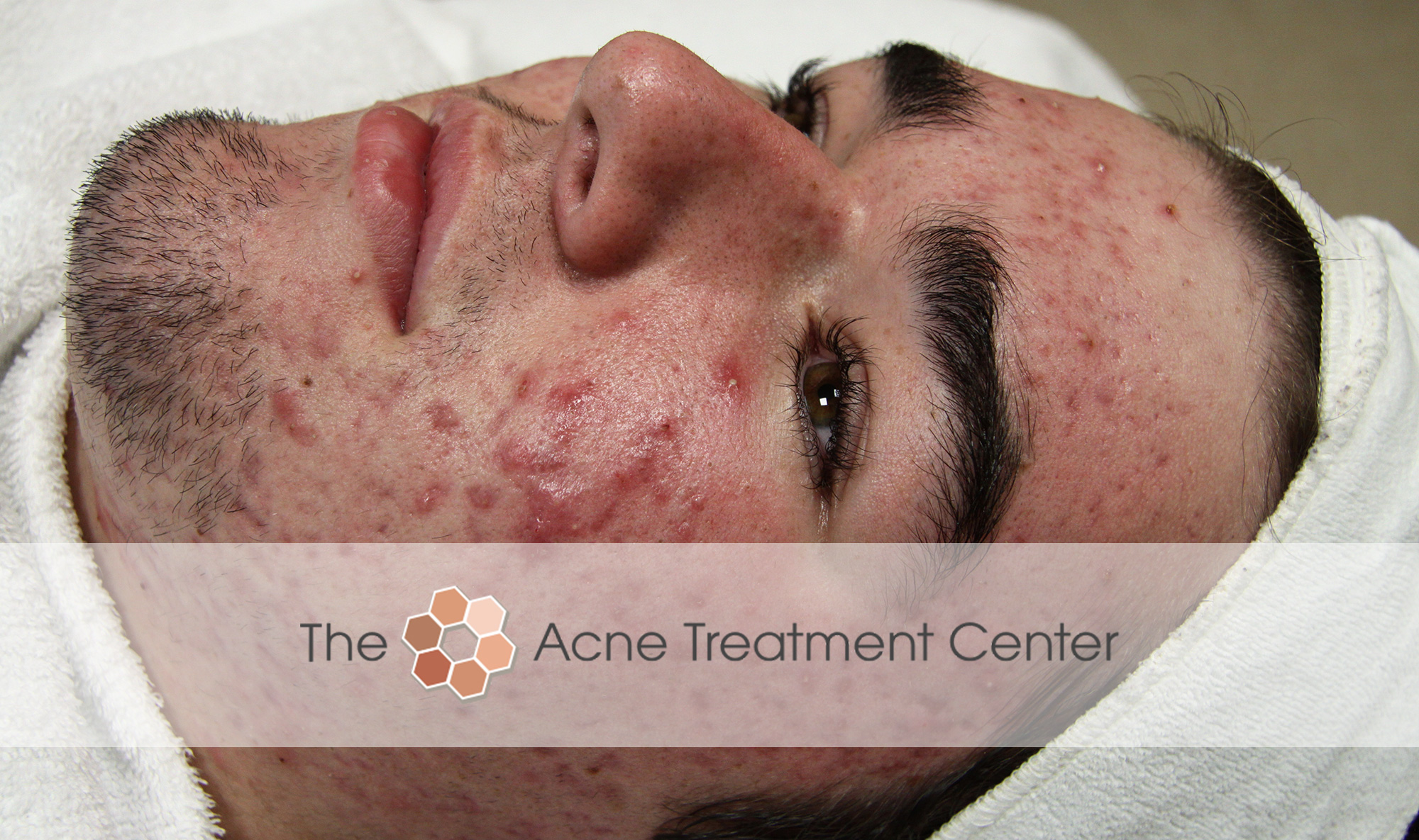 Inflamed Acne Treatment Photo | Acne Treatment Center | Portland OR
