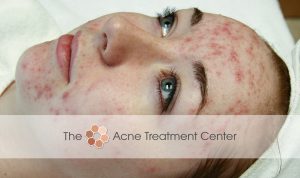 Non Inflamed Acne Treatment Photo