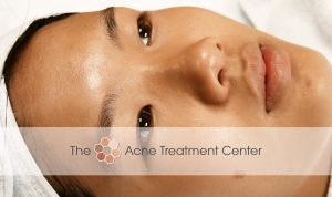 Non Inflamed Acne Treatment Photo