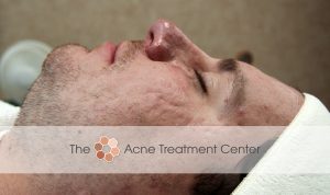Rocasea Acne Treatment Photo