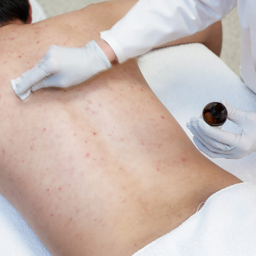 Back and Chest Acne Treatment | Acne Treatment Center