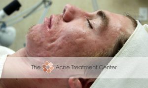 Conglobata Acne Treatment Photo
