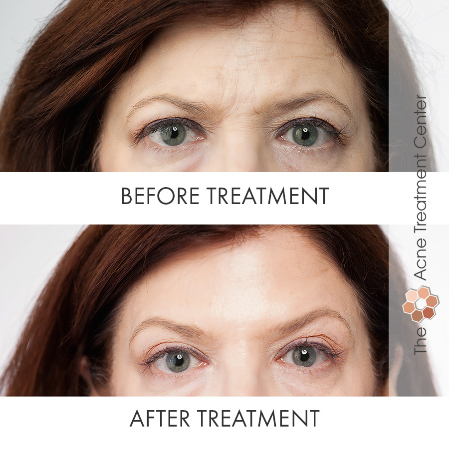 Botox before and after Vancouver WA