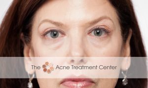 Acne Treatment Center Botox Treatment
