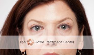 Acne Treatment Center - After Botox Treatment