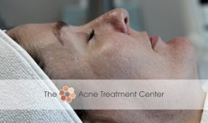Acne Treatment Center in Portland Oregon Treats Sebaceous Hyperplasia
