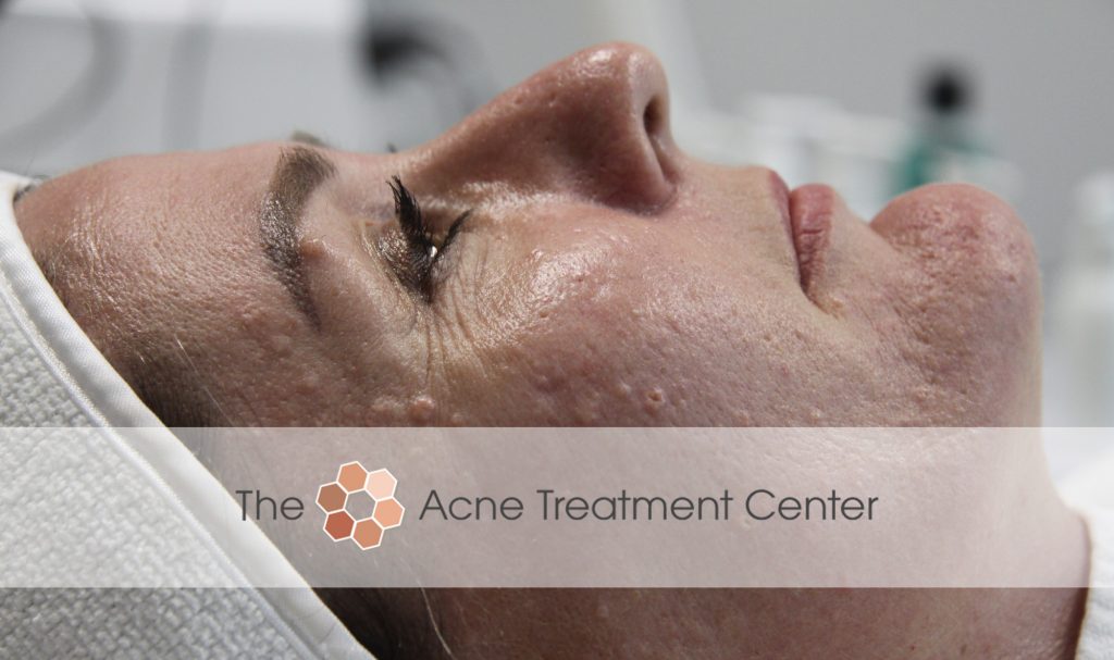 Acne Treatment Center In Portland Oregon Treats Sebaceous Hyperplasia Acne Treatment Center