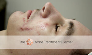 Conglobata Acne Treatment After Photo