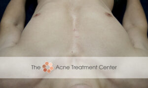 Chest Acne Treatment After Photo