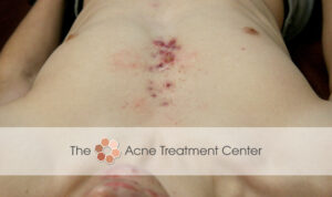 Chest Acne Treatment Before Photo
