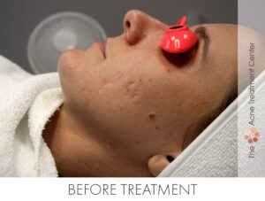 Pitted Acne Scar Treatment | Acne Treatment Center | Before Treatment
