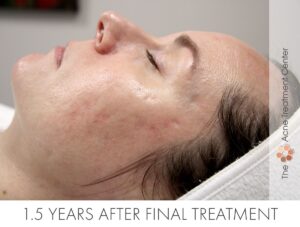 Rolling Acne Scar Treatment | Acne Treatment Center | 1.5 Years After Final Treatment