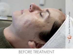 Rolling Acne Scar Treatment | Acne Treatment Center | Before Treatment