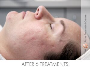 Rolling Acne Scar Treatment | Acne Treatment Center | After 6 Treatments