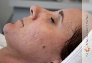 Pitted Acne Scar Treatment | Acne Treatment Center | After 6 Treatments
