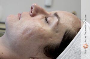 Rolling Acne Scar Treatment | Acne Treatment Center | Before Treatment