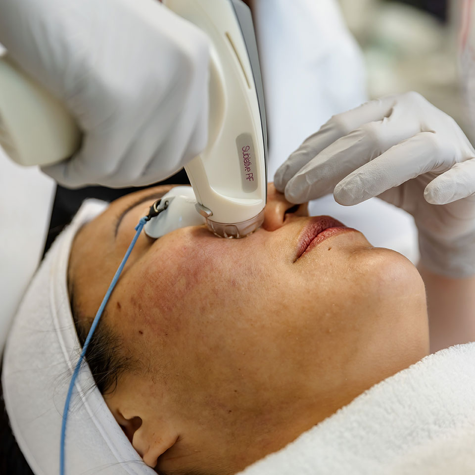 Acne Scar Treatment Service at Acne Treatment Center