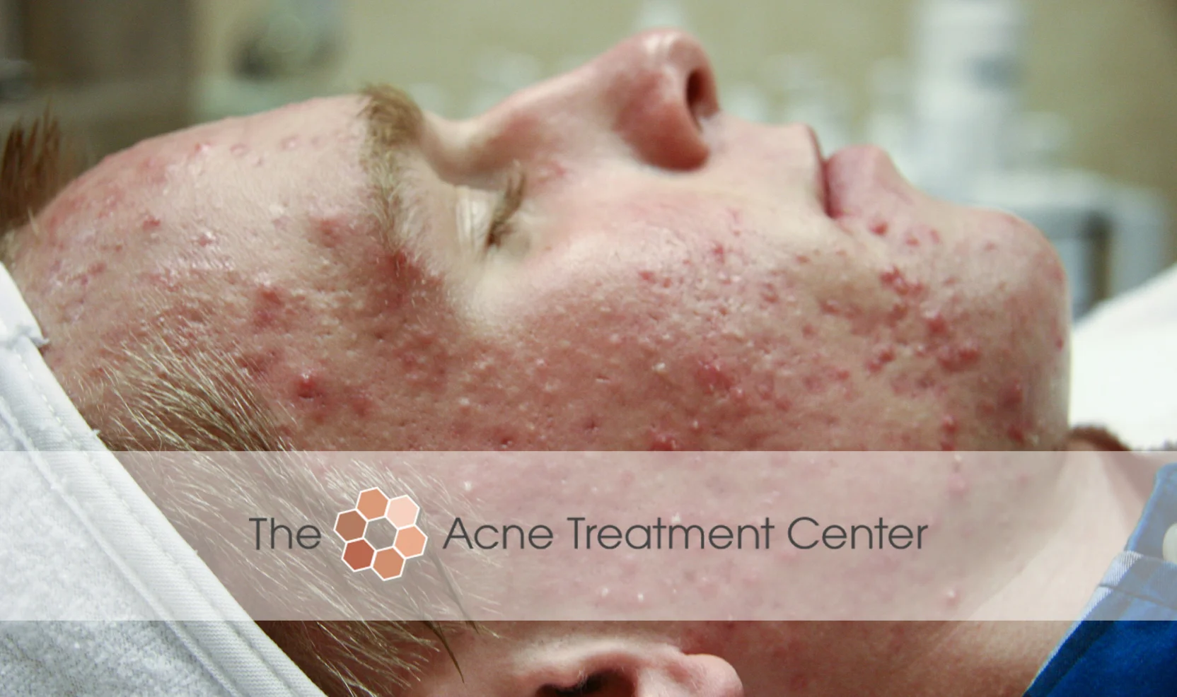 Combination Acne Treatment Photo