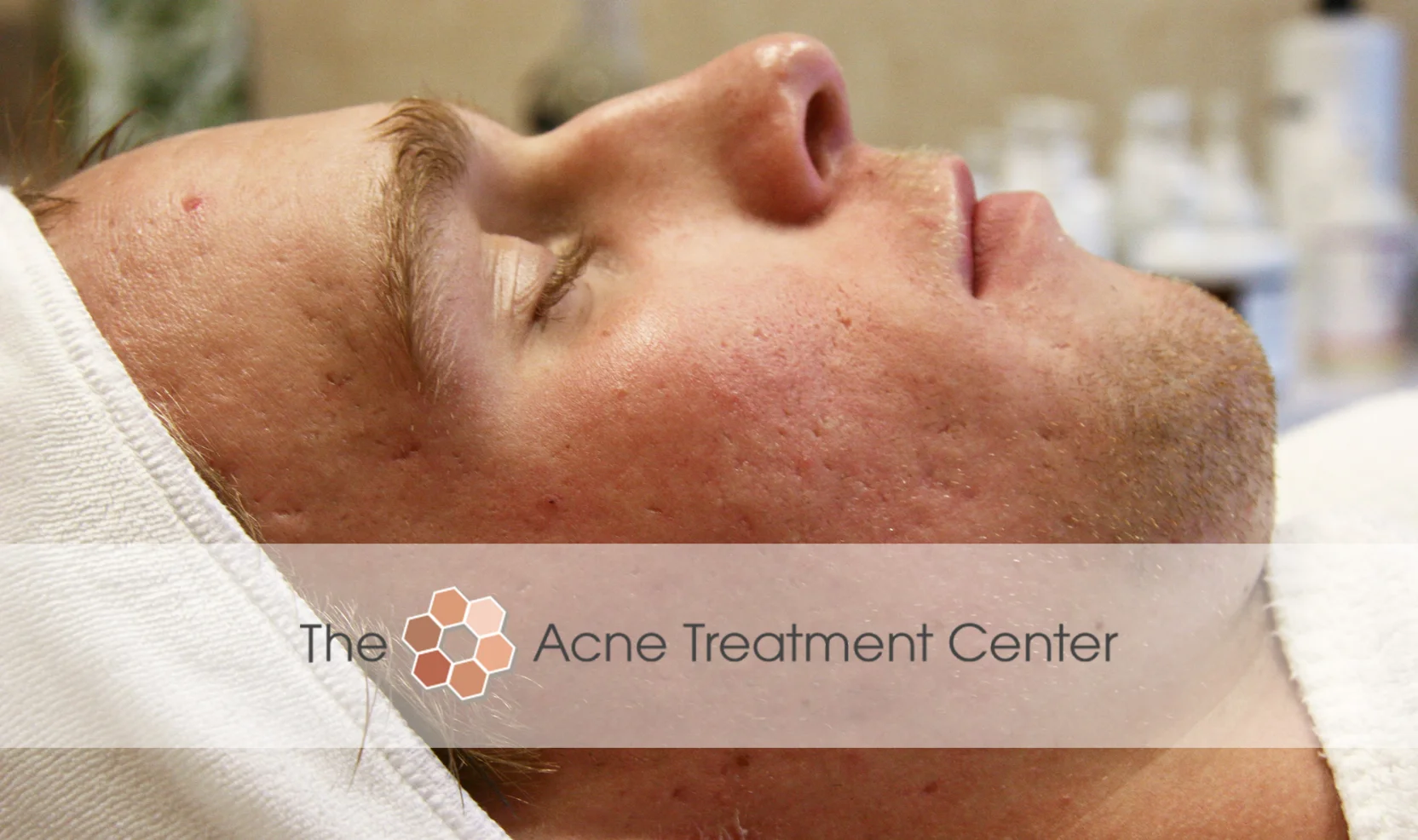Combination Acne Treatment Photo