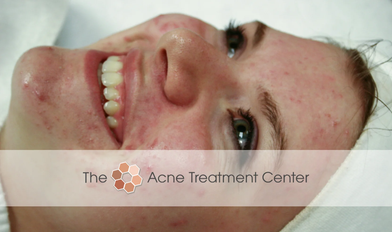Inflamed Acne Treatment Photo