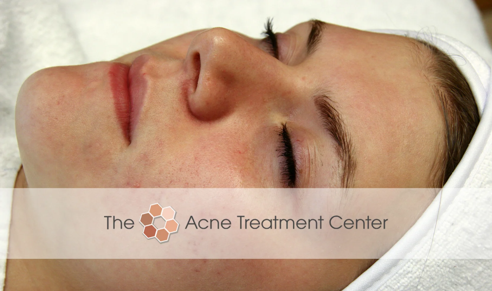 Inflamed Acne Treatment Photo