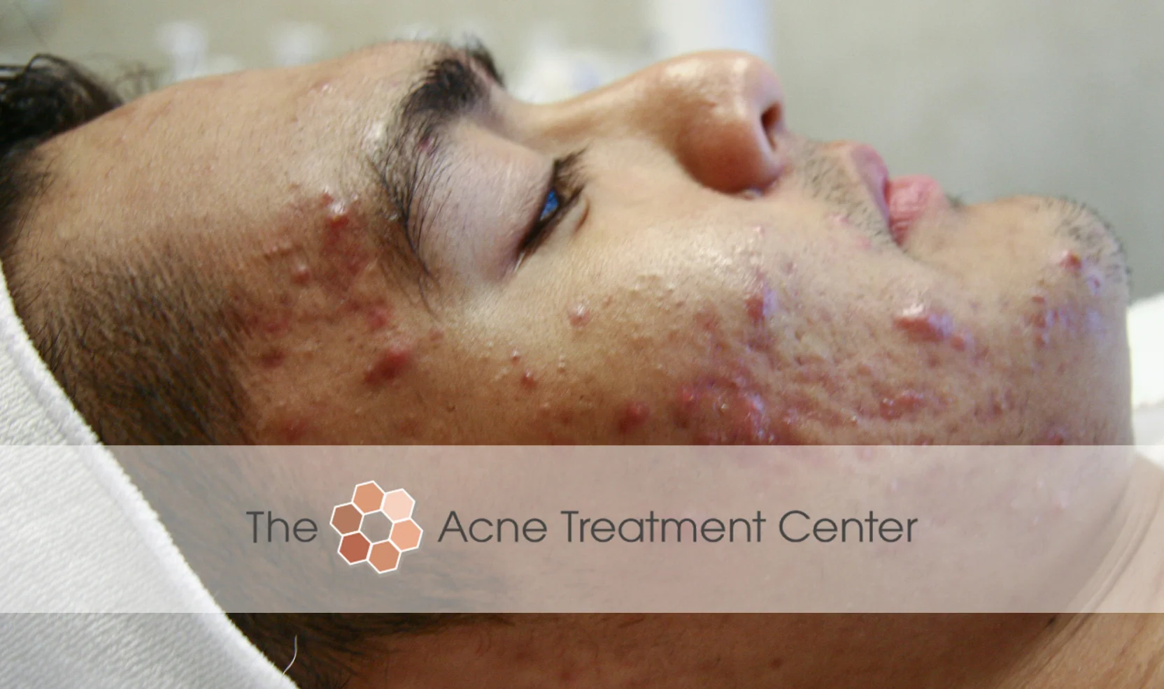 Inflamed Acne Treatment Photo