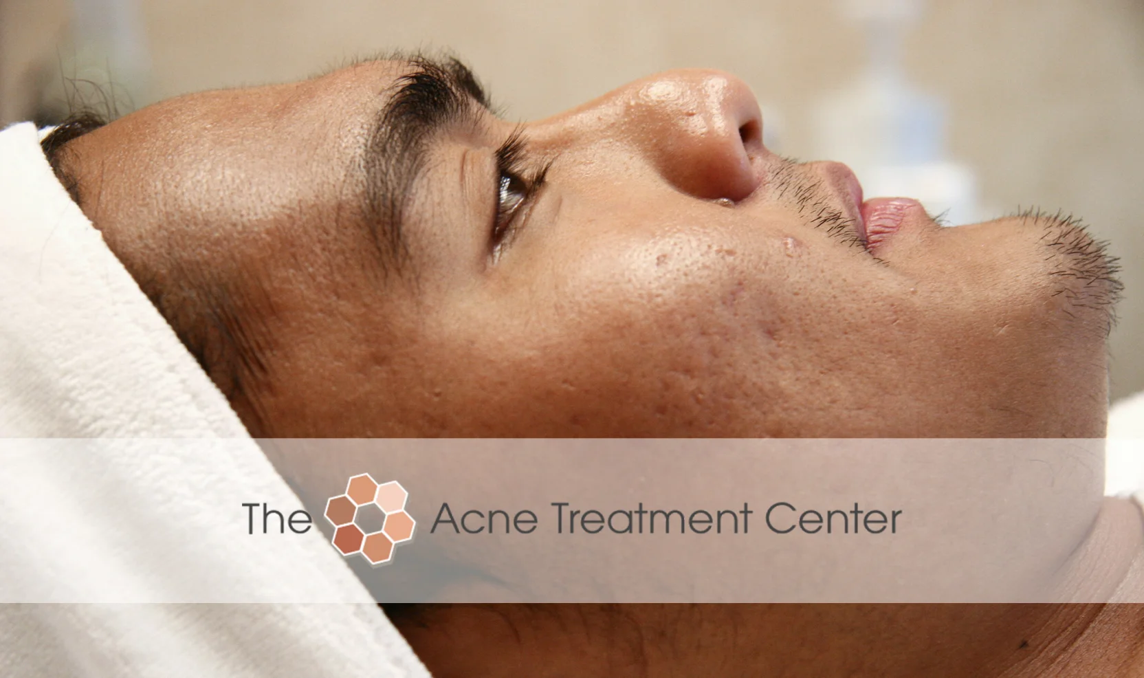 Inflamed Acne Treatment Photo