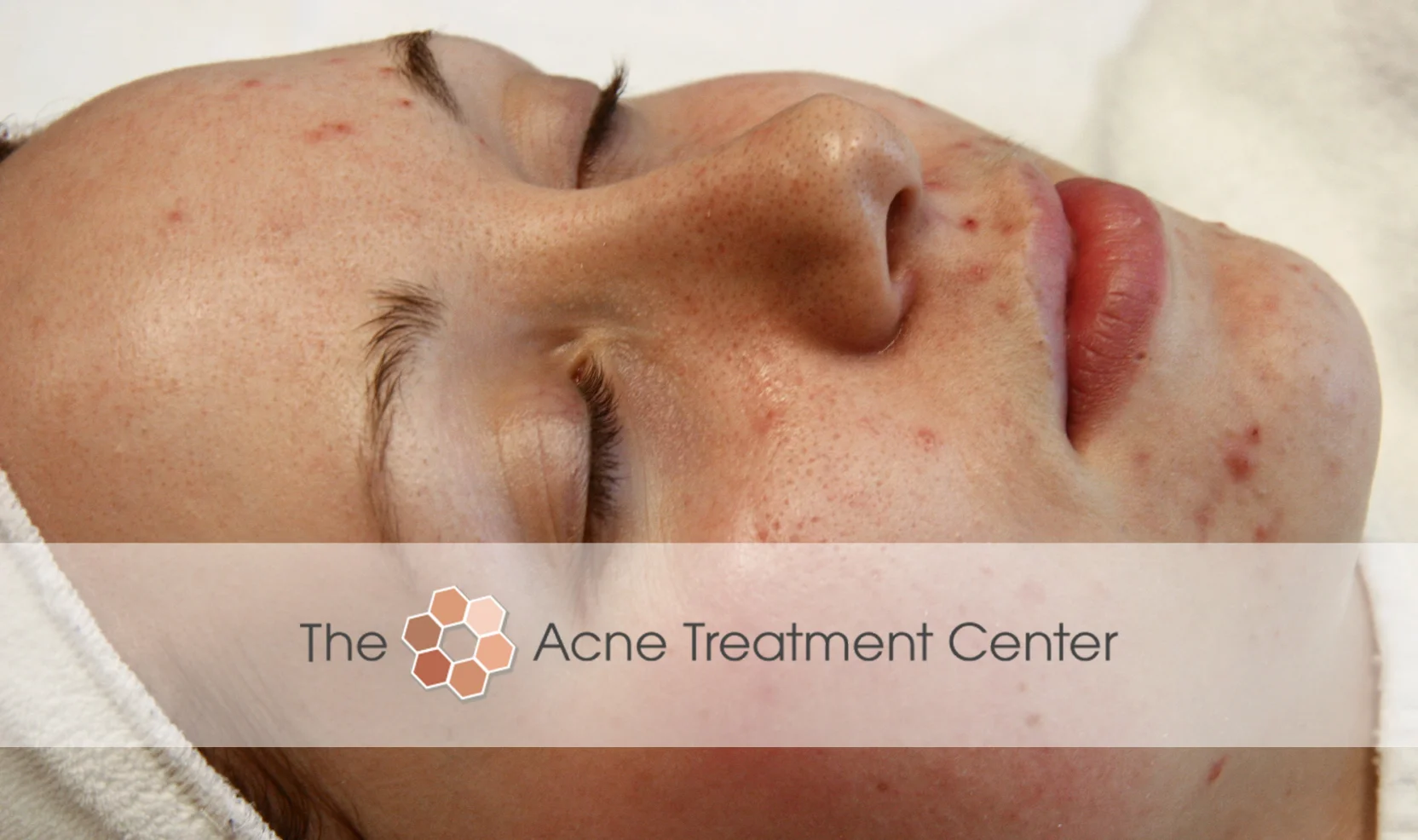 Inflamed Acne Treatment Photo