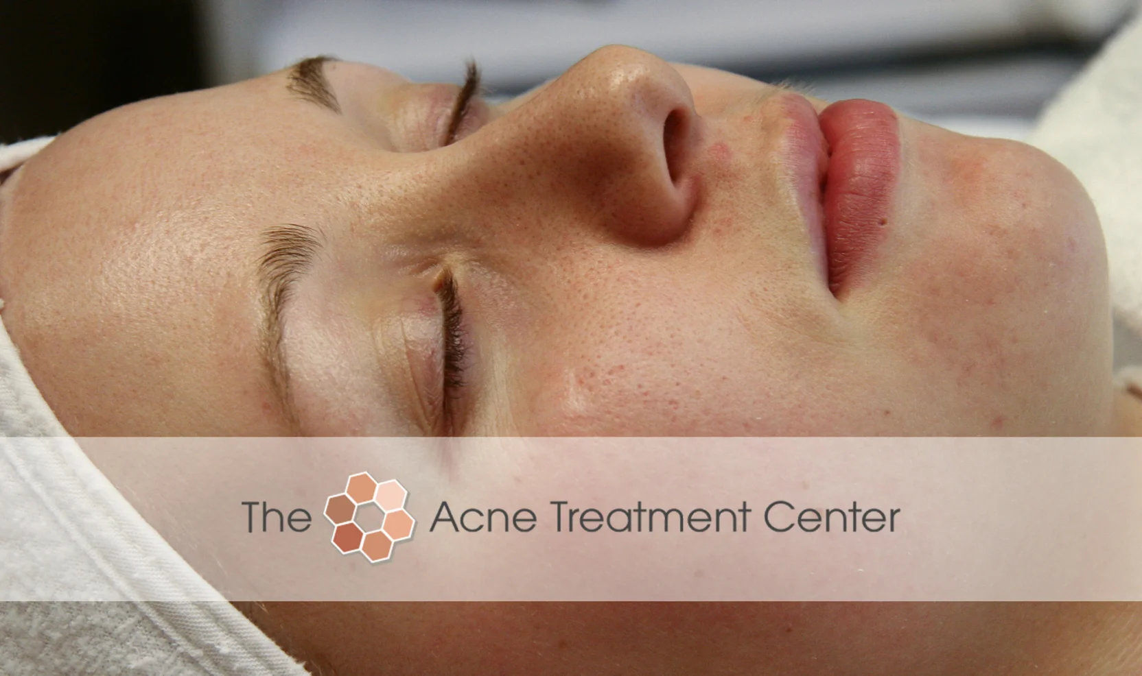 Inflamed Acne Treatment Photo