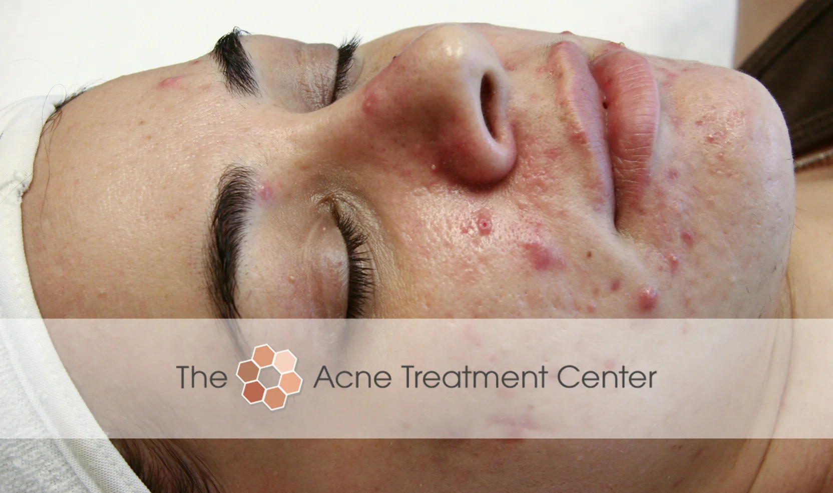 Inflamed Acne Treatment Photo
