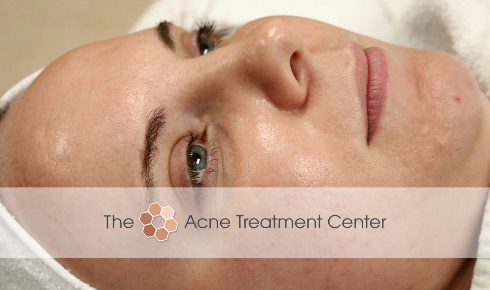 Inflamed Acne Treatment Photo