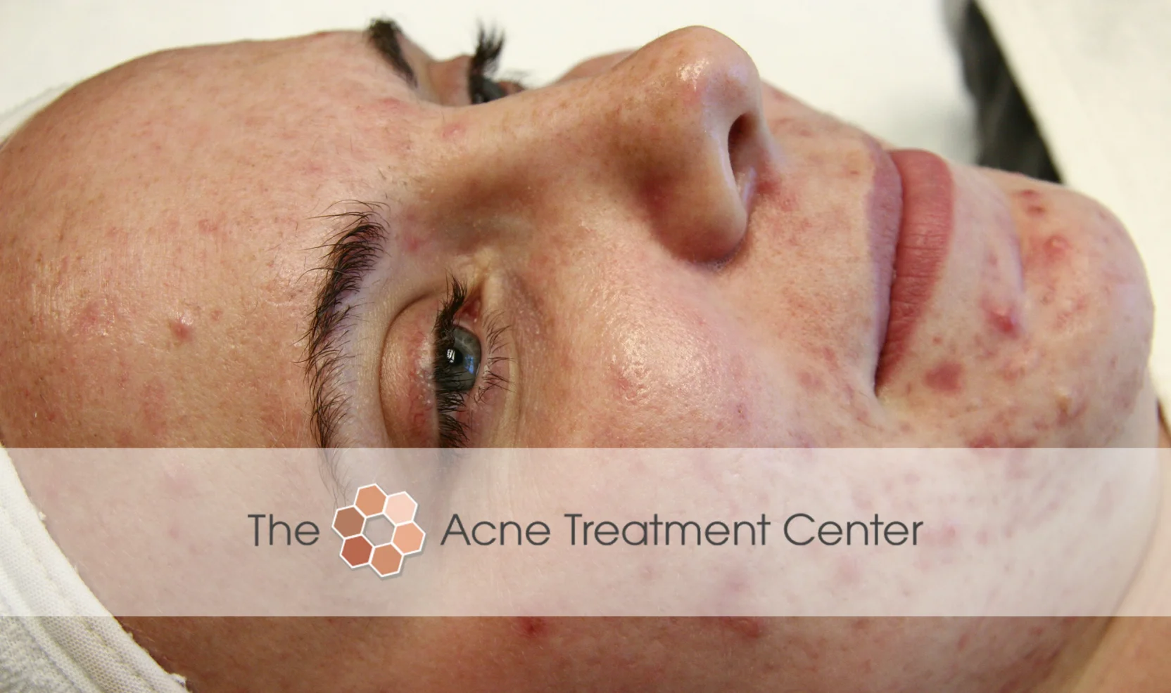 Inflamed Acne Treatment Photo