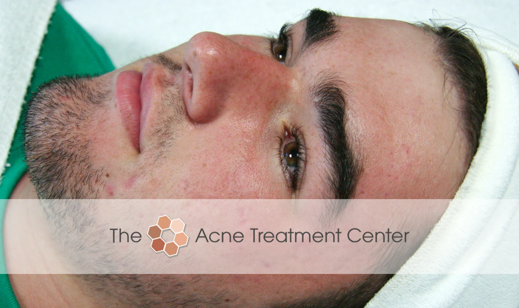 Inflamed Acne Treatment Photo