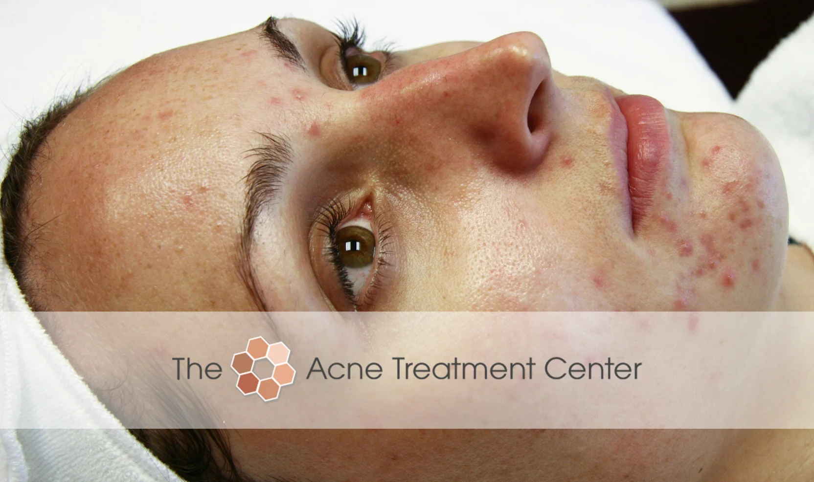 Inflamed Acne Treatment Photo