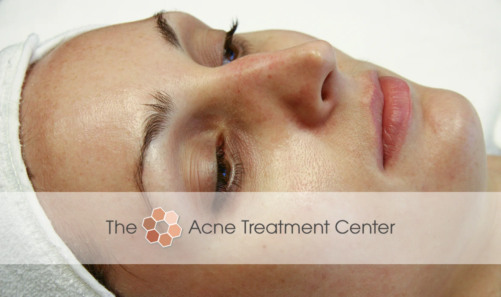 Inflamed Acne Treatment Photo