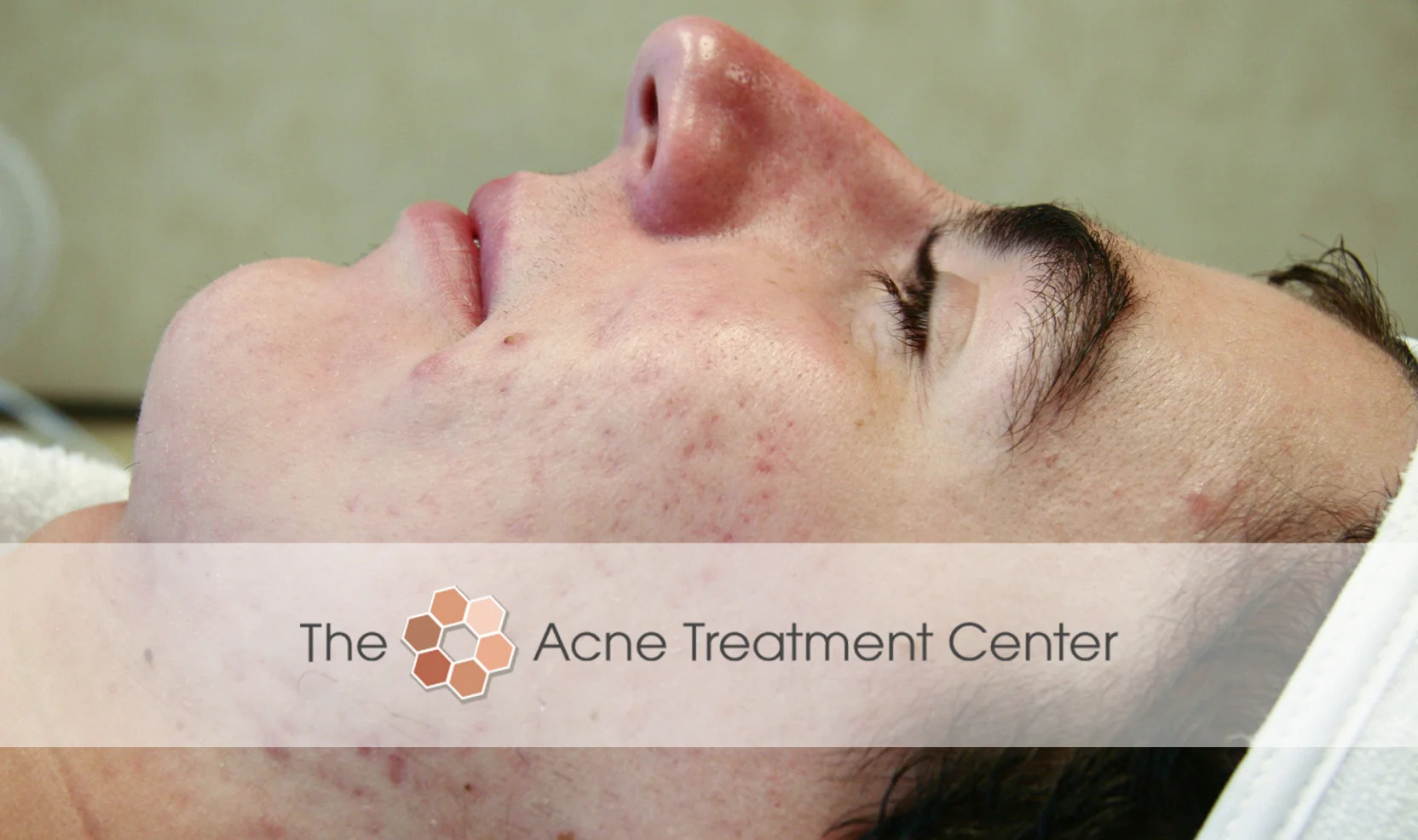 Inflamed Acne Treatment Photo