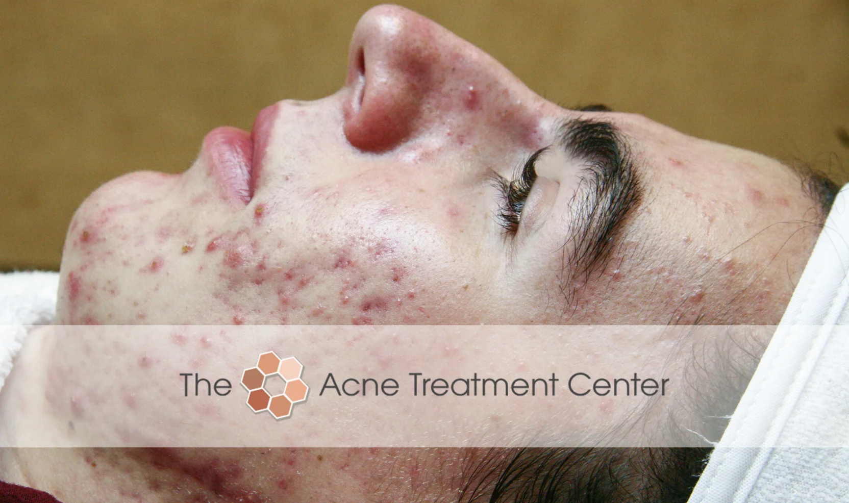 Inflamed Acne Treatment Photo