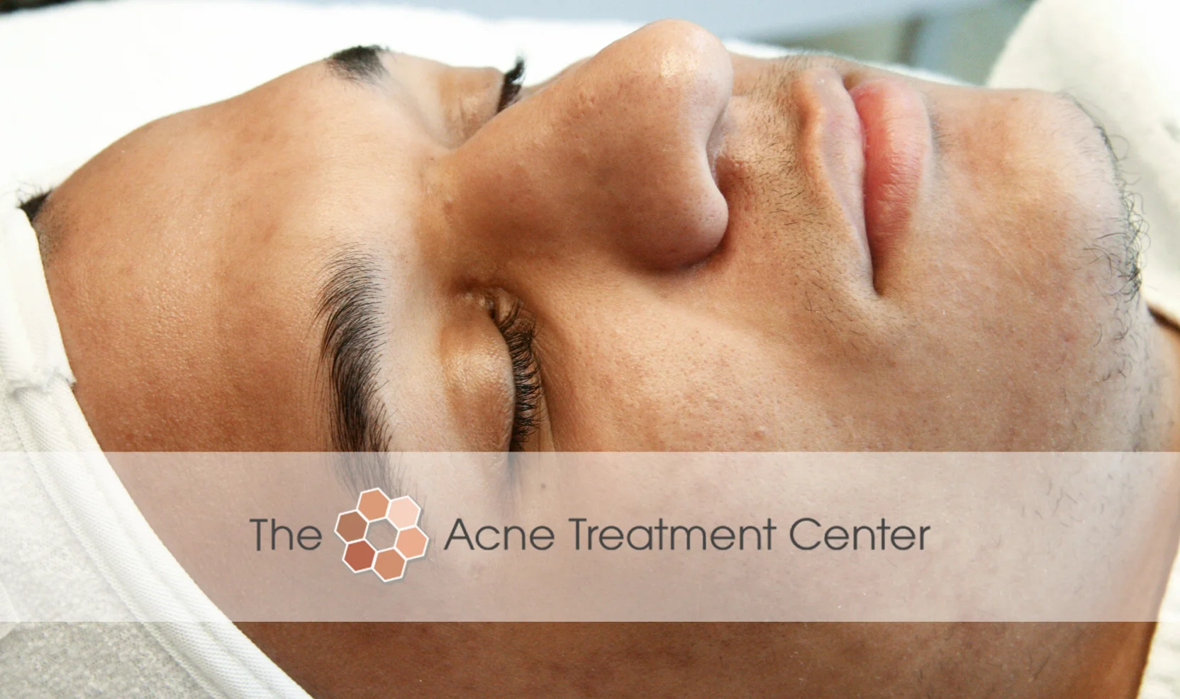 Inflamed Acne Treatment Photo