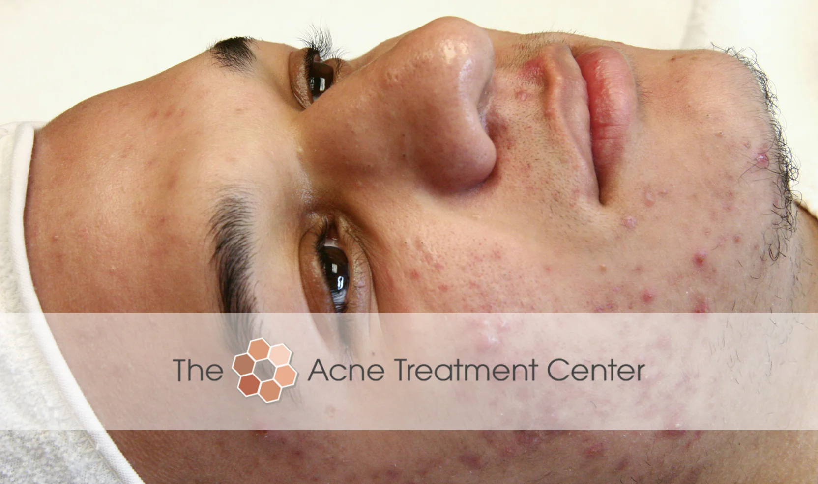 Inflamed Acne Treatment Photo