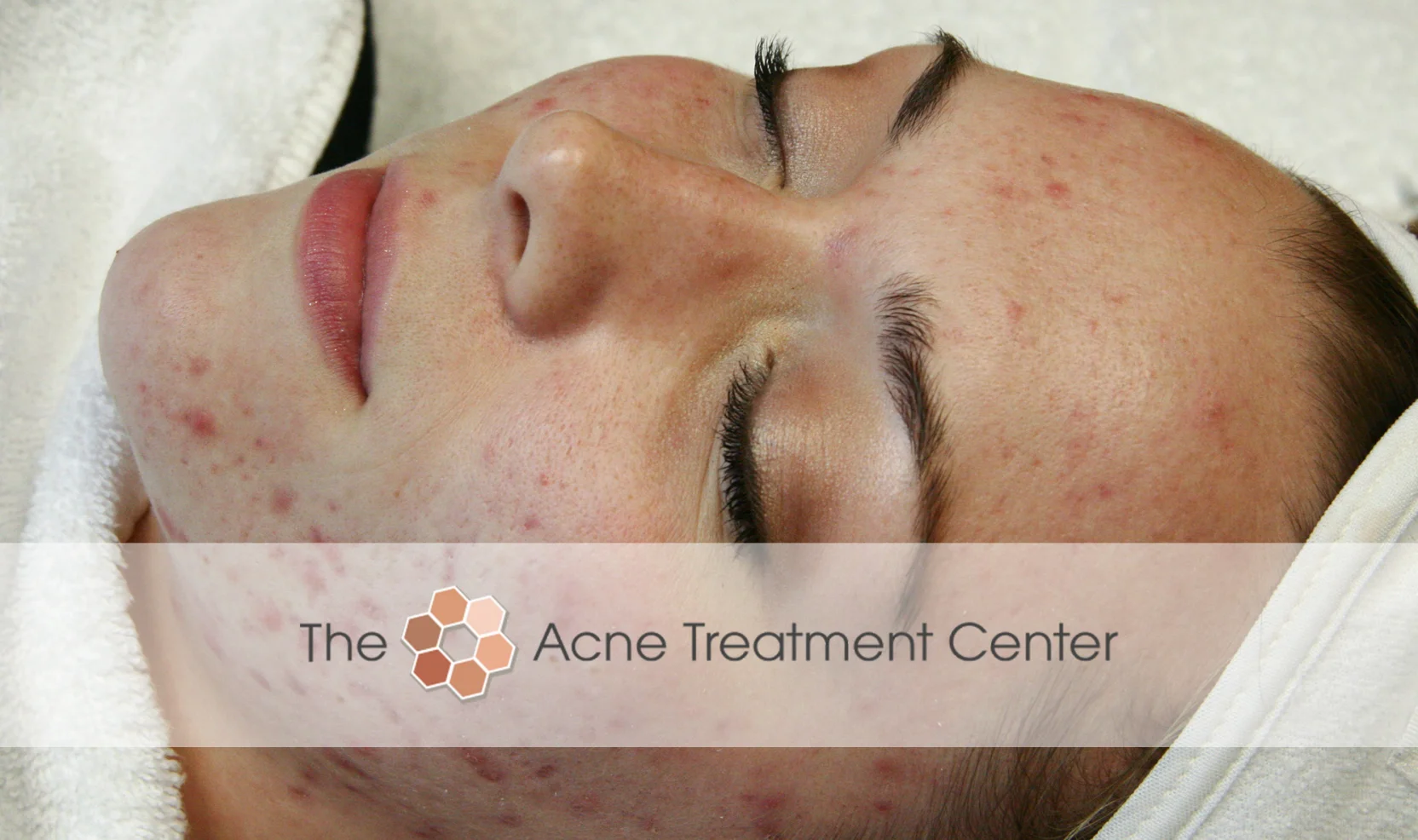 Inflamed Acne Treatment Photo