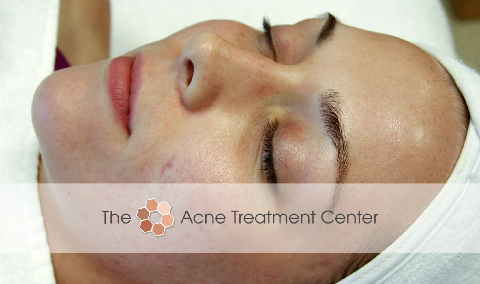 Inflamed Acne Treatment Photo