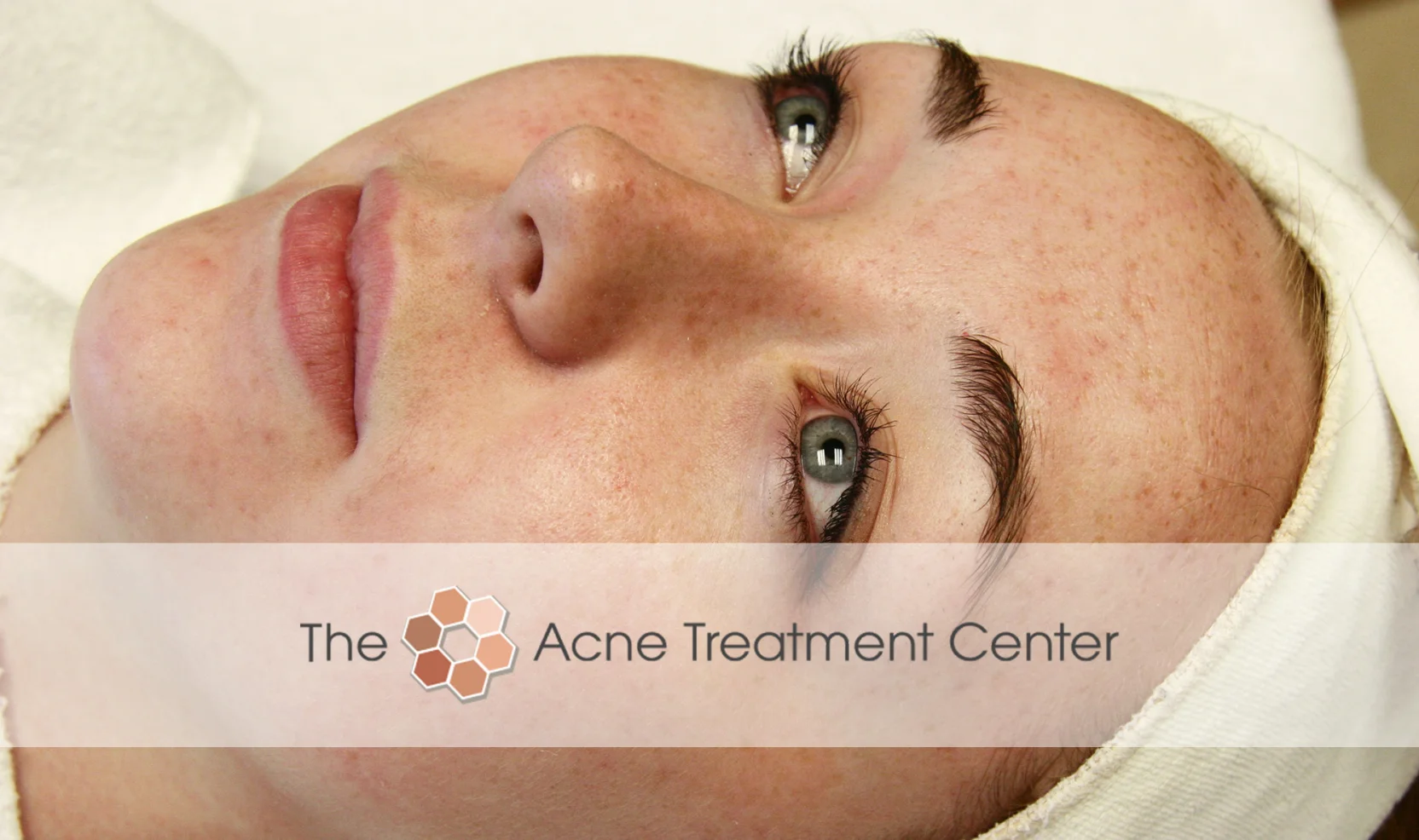 Non Inflamed Acne Treatment Photo