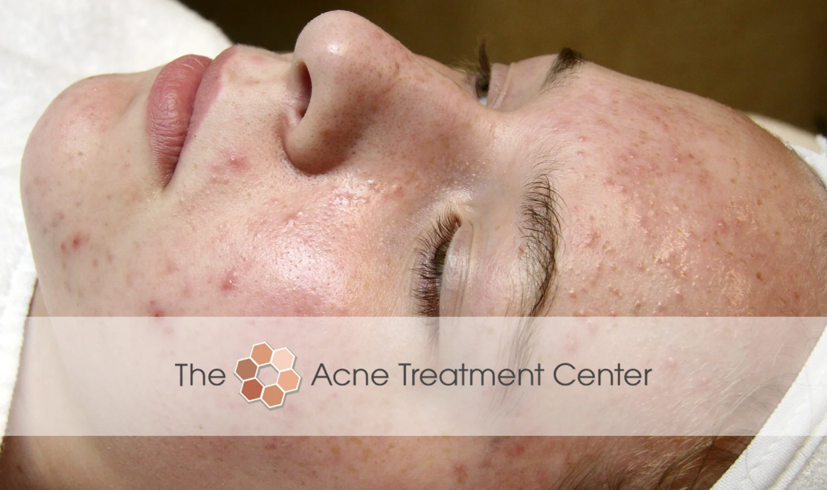 Non Inflamed Acne Treatment Photo